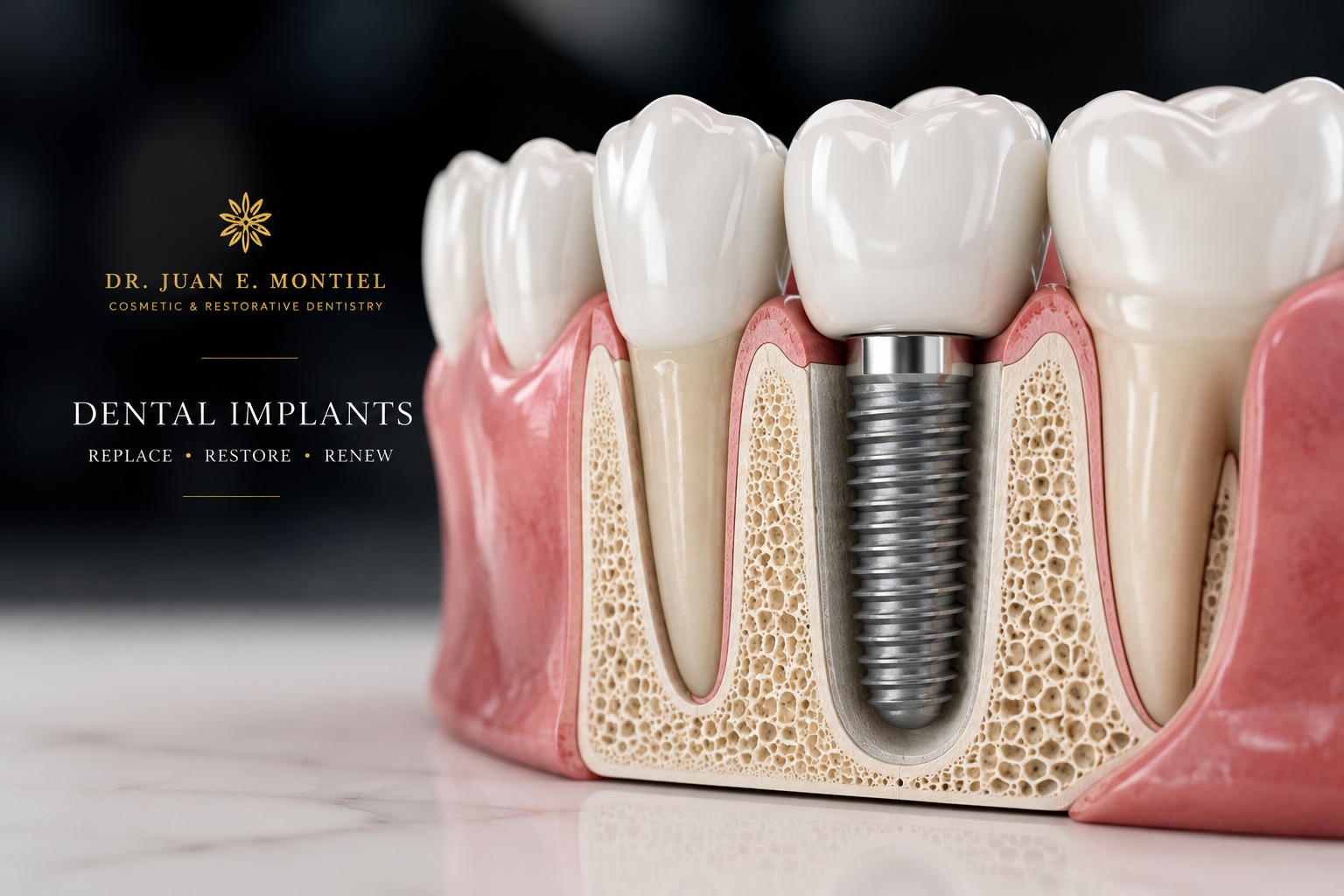 Dental Implants