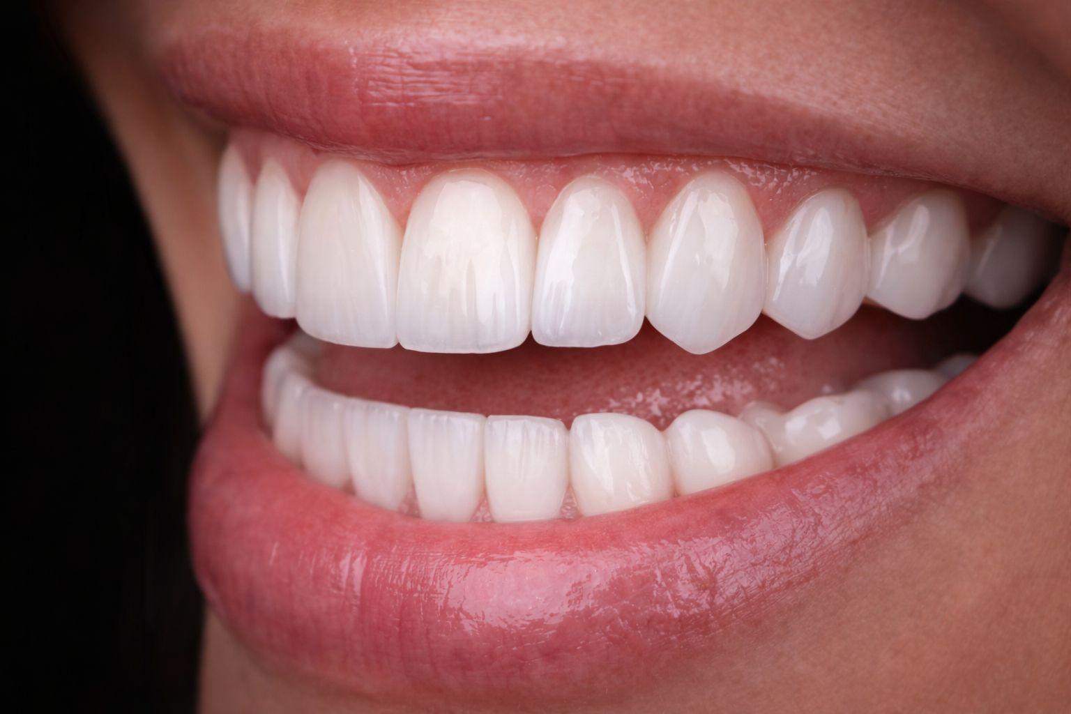 Porcelain Veneers